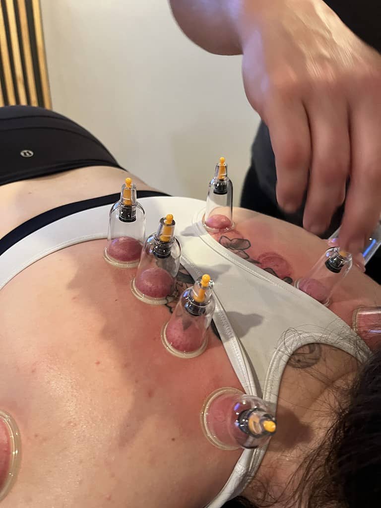 myofascial cupping marks