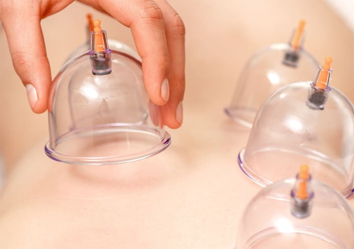 myofascial decompression cupping